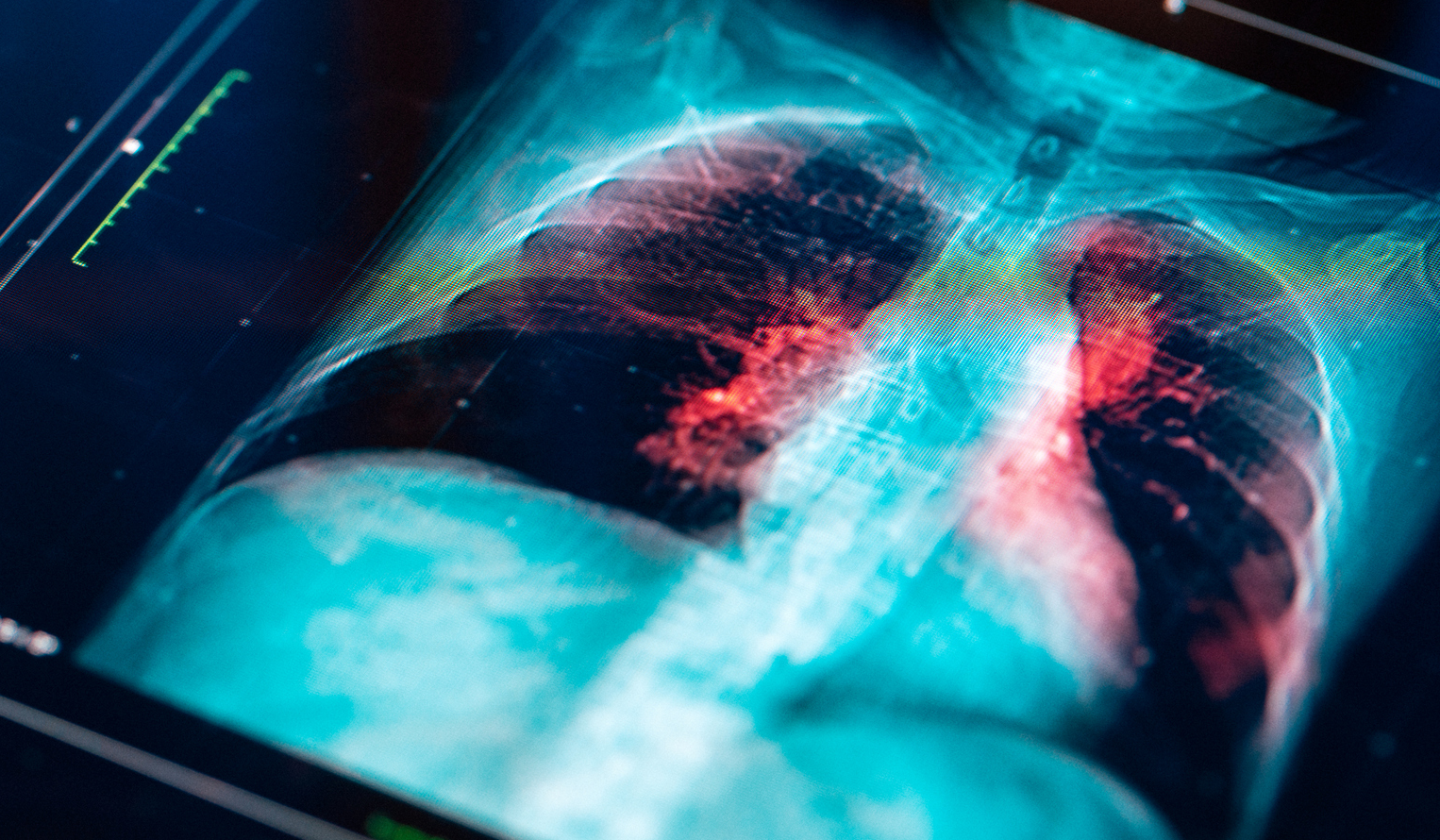 colorful xray image lighting up areas in the lungs